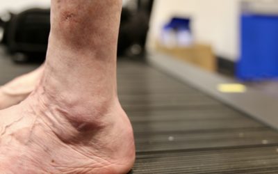 The “Silent” Rupture: The Impact of Long-Term Steroid Use on Biomechanical Integrity